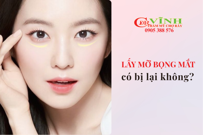 Lấy mỡ bọng mắt có bị lại không? Cách giữ kết quả lâu dài