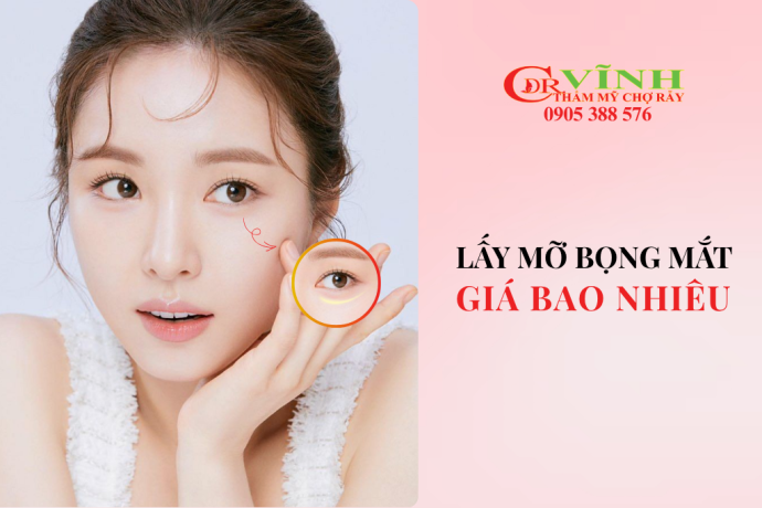 Lấy mỡ bọng mắt giá bao nhiêu? Bảng giá mới nhất hiện nay