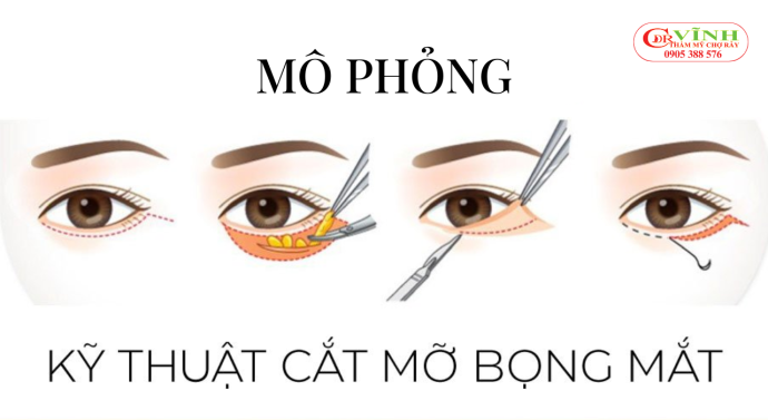 Mô phỏng kỹ thuật lấy mỡ bọng mắt chuẩn y khoa an toàn cho vùng mí dưới