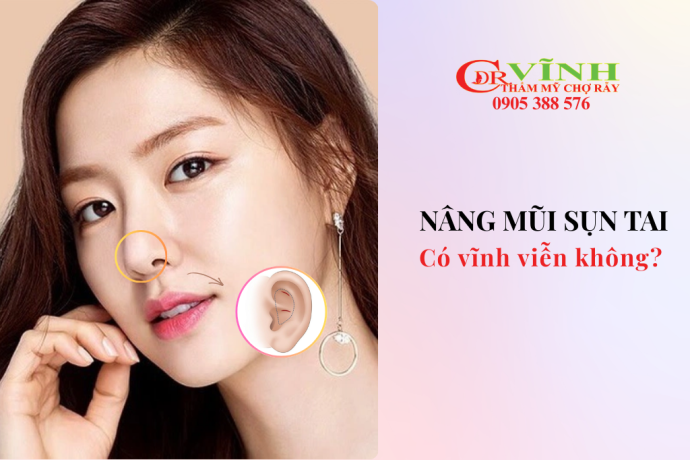 Nâng mũi bằng sụn tai có vĩnh viển không