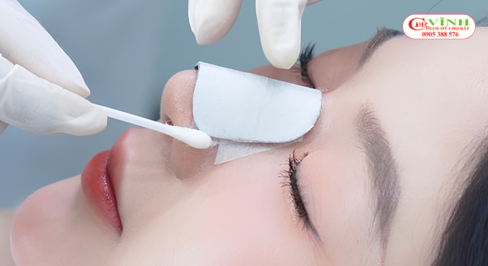 Nâng mũi bao lâu thì sinh hoạt bình thường - giai đoạn tháo nẹp