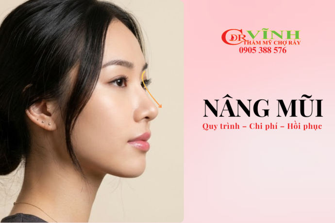 Nâng mũi quy trình chi phí hồi phục