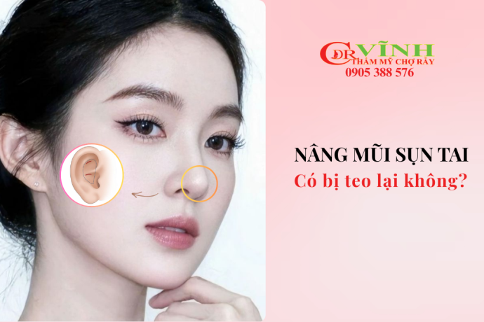 Nâng mũi sụn tai có bị teo không
