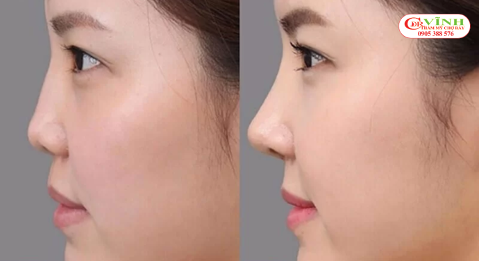 Nâng mũi sụn tai giá bao nhiêu - tình trạng mũi ban đầu của khách hàng