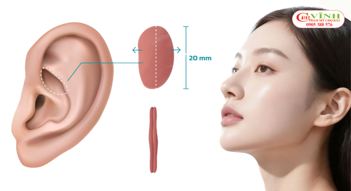Nâng mũi sụn tai giá bao nhiêu - vì sao mỗi nơi có mức giá khác nhau