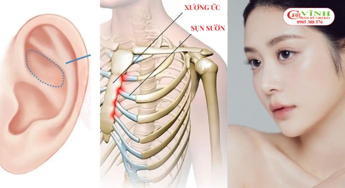 Nên nâng mũi sụn tai hay sụn sườn