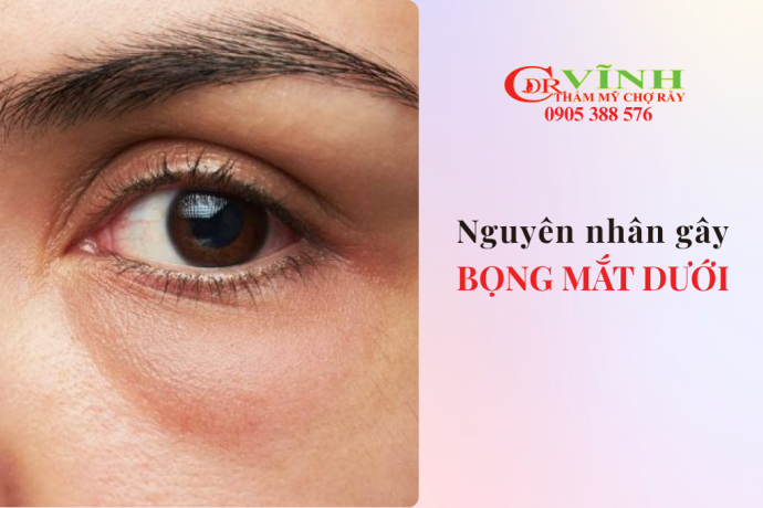 Nguyên nhân gây bọng mắt dưới và cách khắc phục hiệu quả