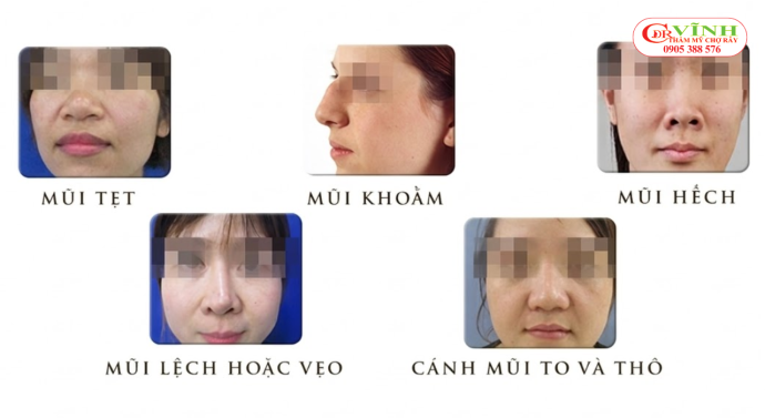 Những trường hợp nên nâng mũi