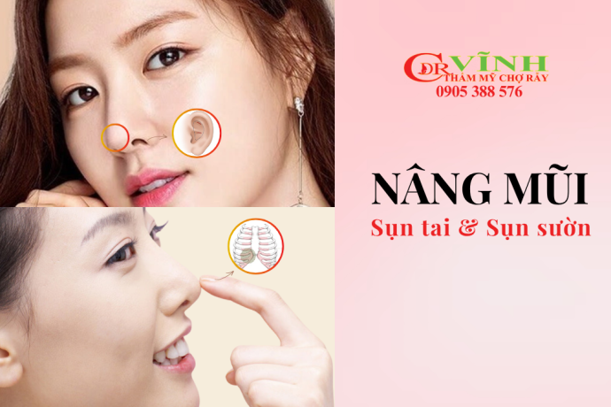 Nâng mũi sụn tai và sụn sườn nên chọn loại nào