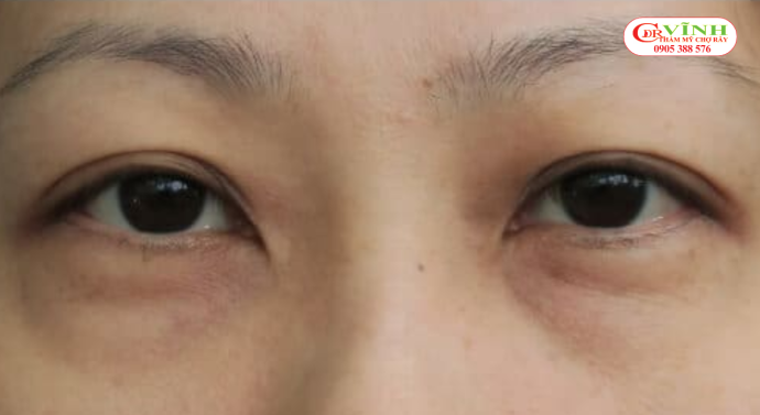 Yếu tố cơ địa và di truyền đối với bọng mắt dưới