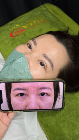 Bác sĩ cắt mí đẹp tại TP.HCM – Tiến sĩ Bác sĩ Lê Hoàng Vĩnh