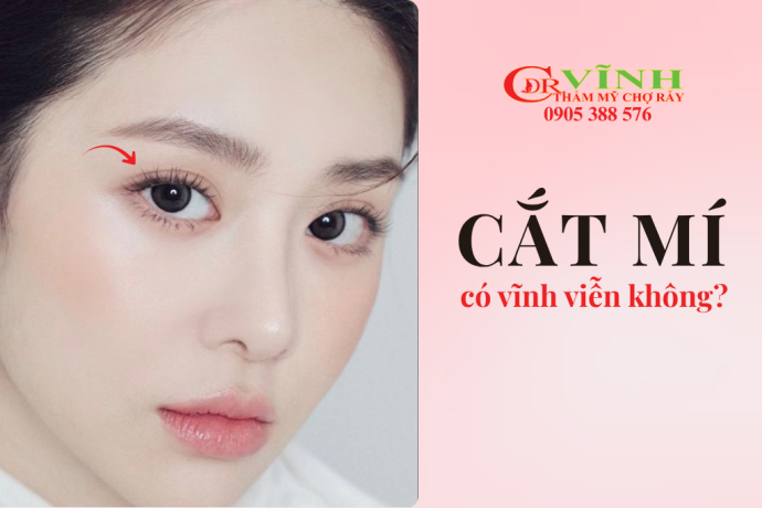Cắt mí mắt có được vĩnh viễn không và các yếu tố ảnh hưởng đến độ bền nếp mí