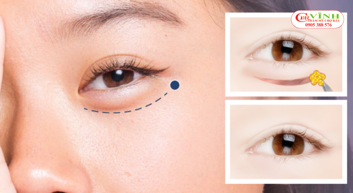 Cắt mí mắt dưới: Bí quyết giúp bạn lấy lại 10 năm tuổi xuân Cắt mí mắt dưới và trẻ hóa vùng mắt tự nhiên