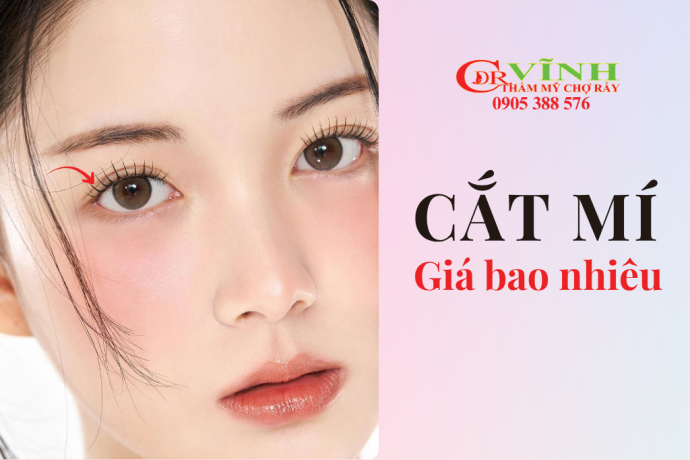 Cắt mắt 2 mí giá bao nhiêu tiền và những lưu ý để tránh ham rẻ dẫn đến biến chứng