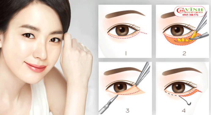 Cắt mí mắt dưới: Bí quyết giúp bạn lấy lại 10 năm tuổi xuân Cấu trúc mí mắt dưới
