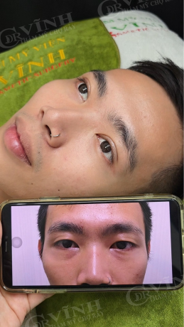 Trước và sau cắt mí mắt do Bác sĩ Thẩm mỹ mắt giỏi thực hiện