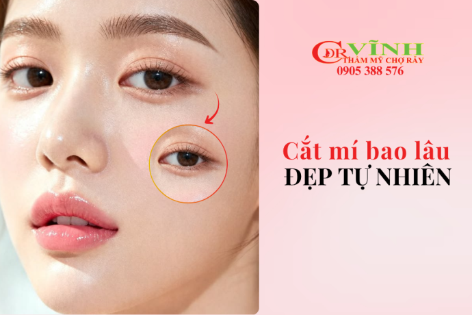 Cắt mí bao lâu thì đẹp tự nhiên