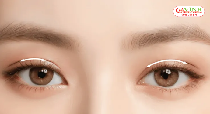 Cắt mí sau bao lâu thì đẹp tự nhiên 