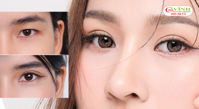 Cắt mí đẹp tự nhiên khác gì với dáng mí quá sâu hoặc quá to?