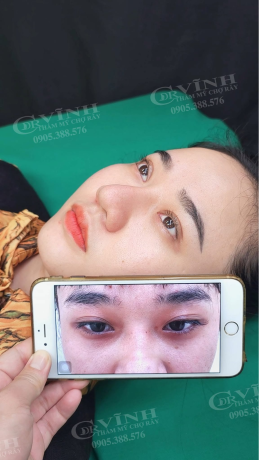 Hình ảnh trước và sau cắt mí mắt với nếp mí tự nhiên và hài hòa khuôn mặt