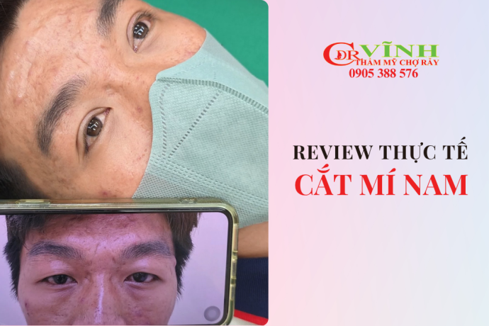 Review cắt mí nam thực tế với kết quả tự nhiên và hài hòa khuôn mặt