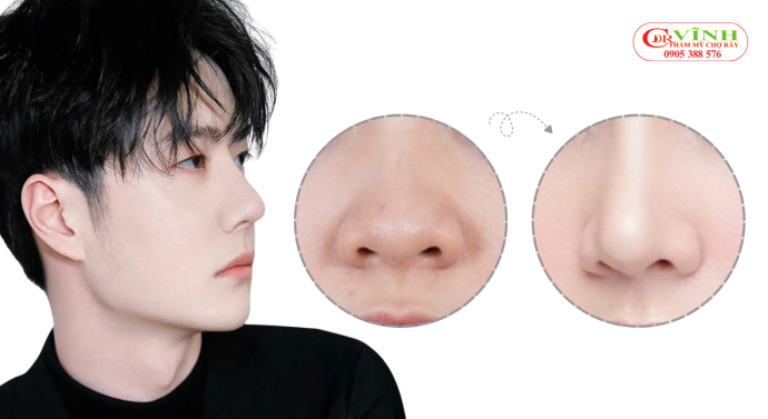 Dáng mũi trước và sau nâng của nam giới