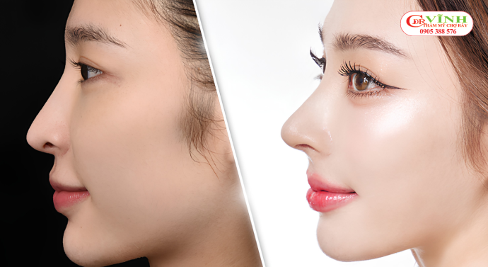 Dấu hiệu nhận biết nâng mũi quá cao