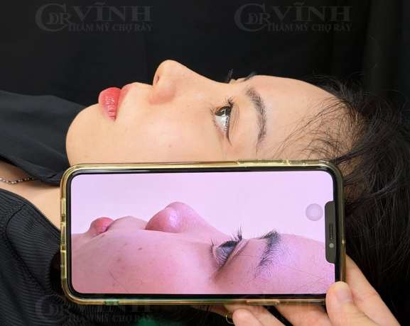 Top 5 dáng mũi đẹp tự nhiên phù hợp với từng khuôn mặt Dáng mũi đẹp chuẩn Á Đông với sống mũi cao tự nhiên và đầu mũi thanh gọn