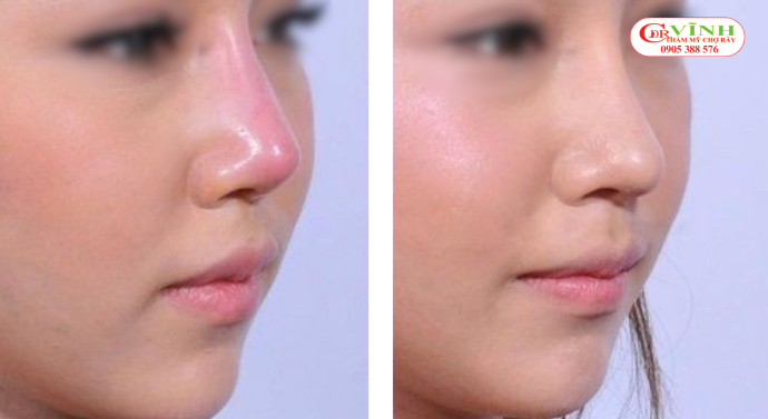 Lộ sống sau nâng mũi có thể liên quan đến da mũi mỏng và độ cao sống mũi không phù hợp