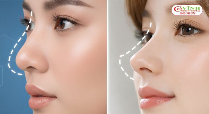 Độ cao của mũi cần được điều chỉnh phù hợp với đường nét khuôn mặt khi nâng mũi cho mặt vuông