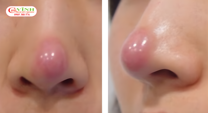 Nâng mũi quá cao có thể gây bóng đỏ đầu mũi