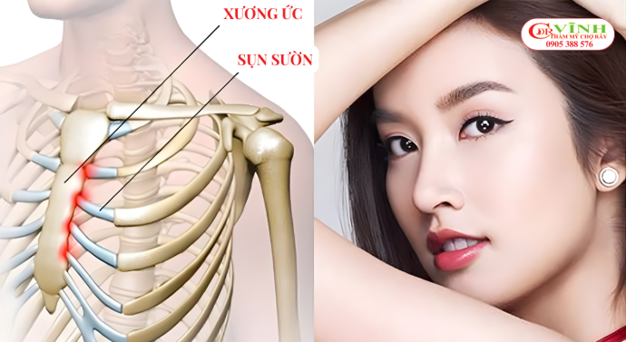 Nâng mũi sụn sườn có teo lại không?