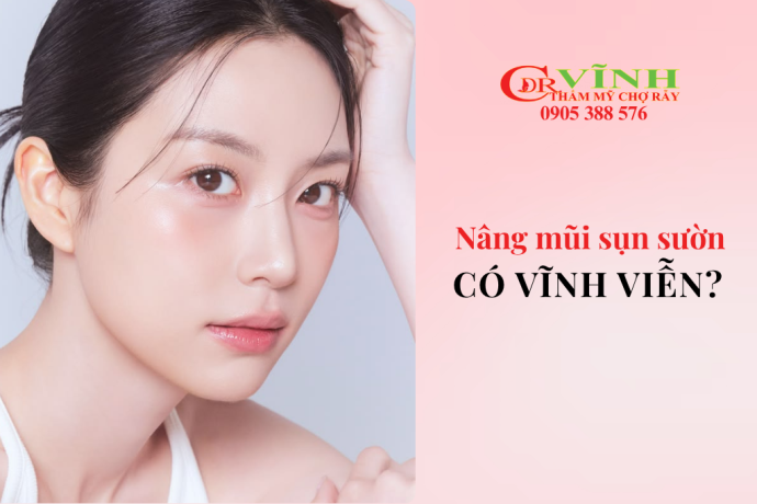 Nâng mũi sụn sườn giữ được bao lâu? Có vĩnh viễn không