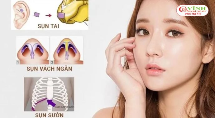 Sụn tự thân không phải là yếu tố quyết định dáng mũi đẹp tự nhiên