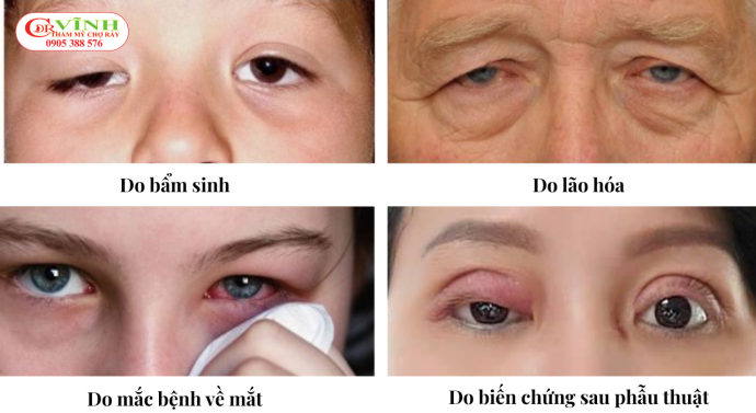 Nguyên nhân gây sụp mí mắt