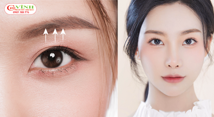 Phẫu thuật sụp mí mắt giúp mắt đẹp tự nhiên