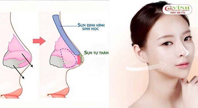 Phương pháp và chất liệu phù hợp giúp tạo dáng mũi hài hòa, tự nhiên hơn cho người có da mũi mỏng