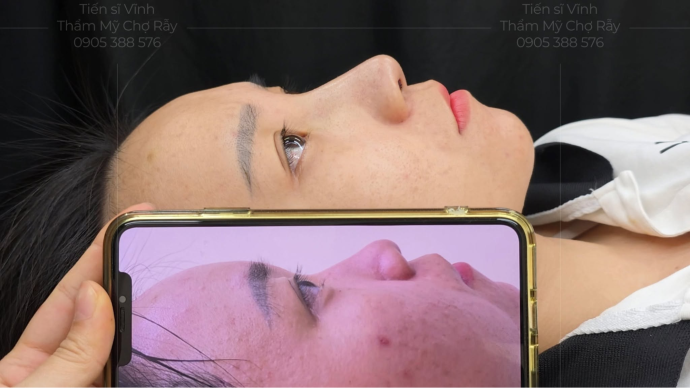 Top 5 dáng mũi đẹp tự nhiên phù hợp với từng khuôn mặt Dáng mũi thanh tú với đường nét hài hòa, tự nhiên và cân đối