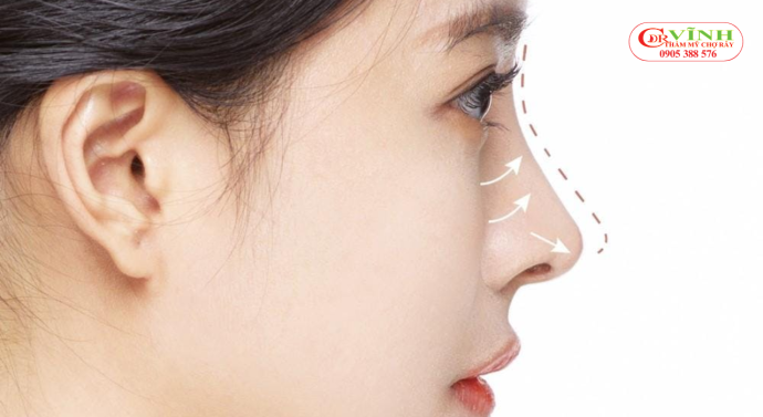 Xu hướng thẩm mỹ nâng mũi tự nhiên