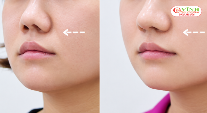 Mỗi trường hợp có nền mũi và cấu trúc khác nhau nên phương án nâng mũi cần được cá nhân hóa