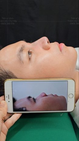 Dáng mũi sau nâng đẹp bởi Tiến sĩ Bác sĩ Lê Hoàng Vĩnh tự nhiên hài hòa với gương mặt