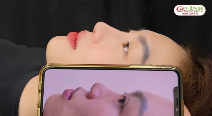 Hình ảnh nâng mũi sụn tai đẹp tự nhiên tại Phòng khám Thẩm mỹ Tiến sĩ Vĩnh - Chợ Rẫy
