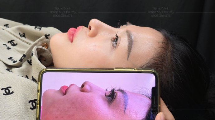 Kết hợp chỉnh sửa đầu mũi để cải thiện chiều dài một cách tự nhiên