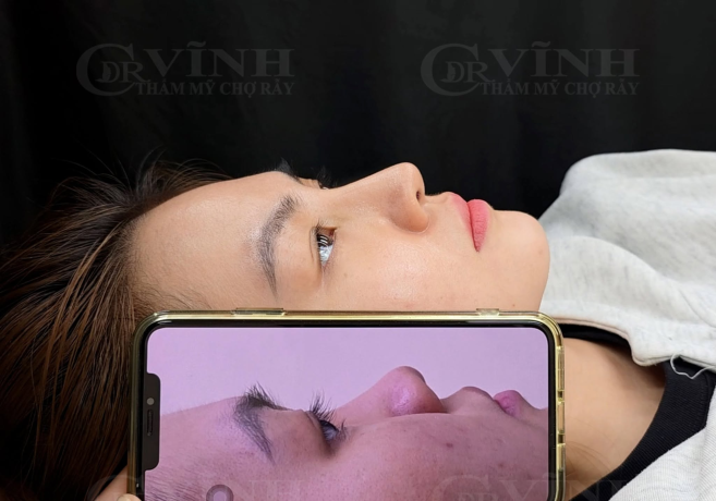 Dáng mũi hoàn toàn ổn định, mềm mại và tự nhiên sau 3 đến 6 tháng phục hồi.