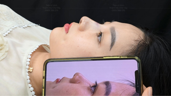 Dáng mũi ở thời điểm 14 ngày sau phẫu thuật: Mũi đã vào phom cơ bản nhưng vẫn đang trong quá trình giảm sưng