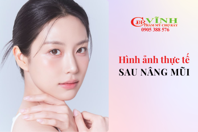 Hình ảnh thực tế sau nâng mũi: Hình ảnh trước và sau của khách hàng