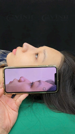 Hình ảnh thực tế trước và sau chỉnh mũi gồ: Đường sống mượt mà, giữ nguyên nét tự nhiên