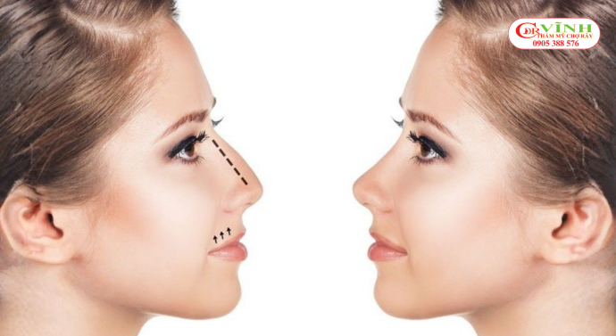 Xử lý phẳng điểm gồ trước khi tạo hình sống mũi mới