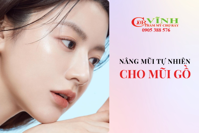 Mũi gồ có nâng mũi tự nhiên được không? Giải pháp chỉnh hình an toàn
