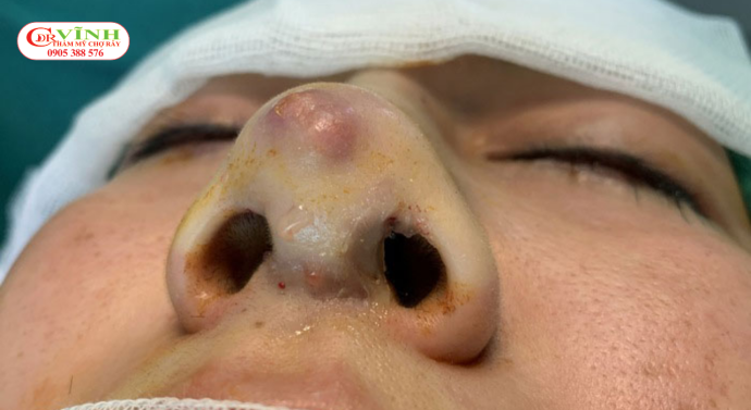 Trước khi sửa mũi hỏng cần đánh giá tình trạng cấu trúc, mô mềm và những thay đổi sau các lần phẫu thuật trước